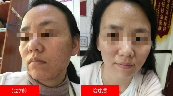 华肤“双11战痘节”，一个更有颜值的节日盛会